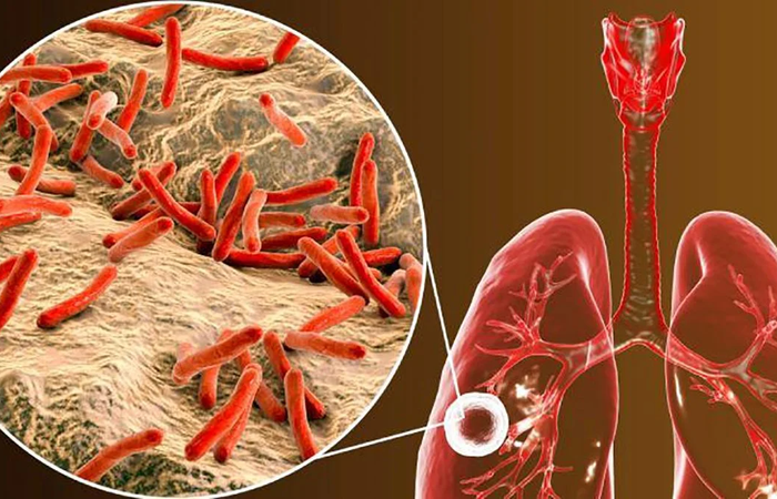 PREOCUPACIÓN EN EL PAÍS: LOS CASOS DE TUBERCULOSIS AUMENTARON MÁS DE UN 70% Y YA CAUSAN UNA MUERTE CADA 7 HORAS